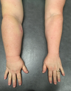 lymphedema arms